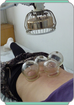 cupping treatment with heatlamp