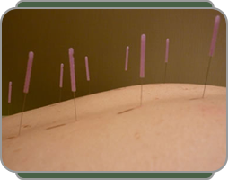 picture of patient having multi point acupuncture insertions at Bodyharmonics
