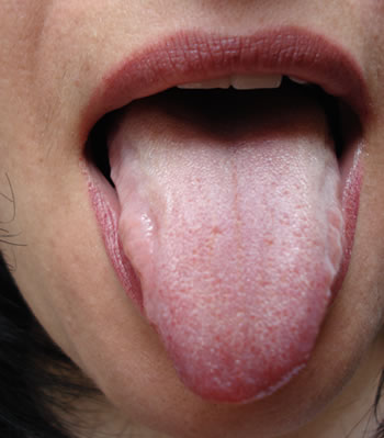 Tongue pictures